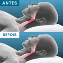 Animação comparativa de vias aéreas antes e depois do uso de protetor bucal